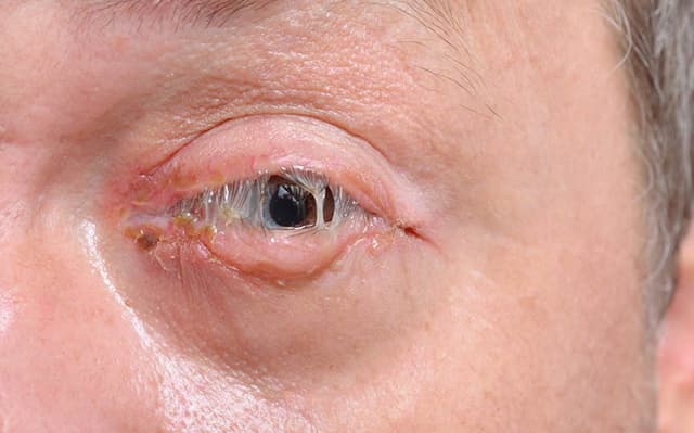 Conjuntivitis