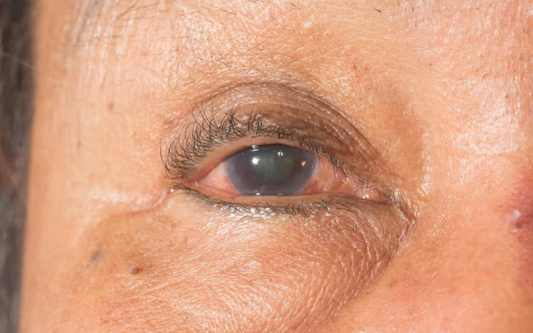 Glaucoma y glaucoma neovascular