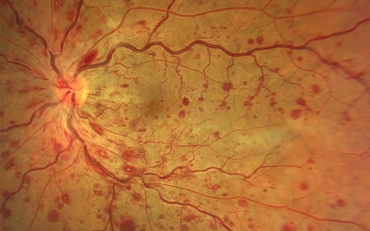 Oclusiones vasculares de la retina