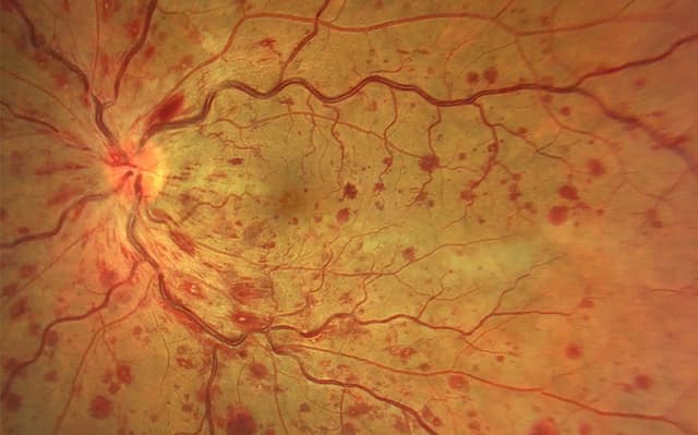 Oclusiones vasculares de la retina
