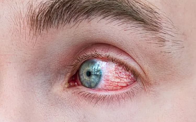 Ojo seco