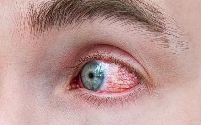 Ojo seco