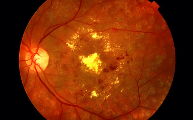 Retinopatía diabética