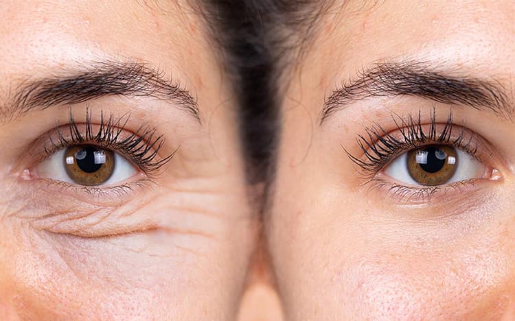 Blefaroplastia