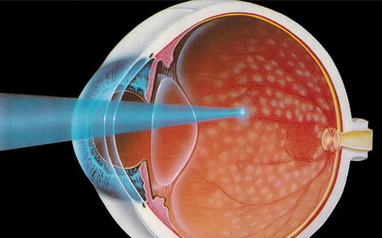 Tratamiento láser para retinopatía diabética